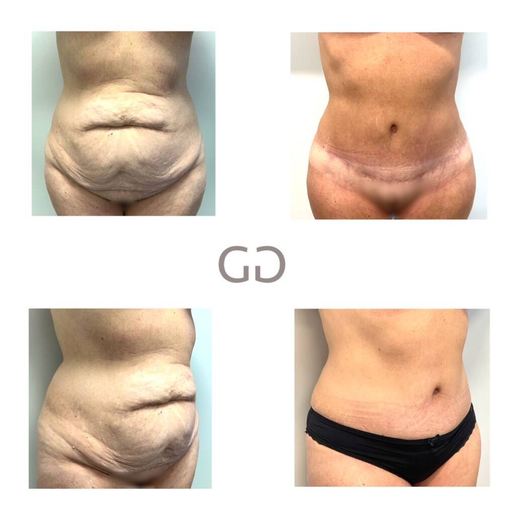 Abdominoplastie-montreal