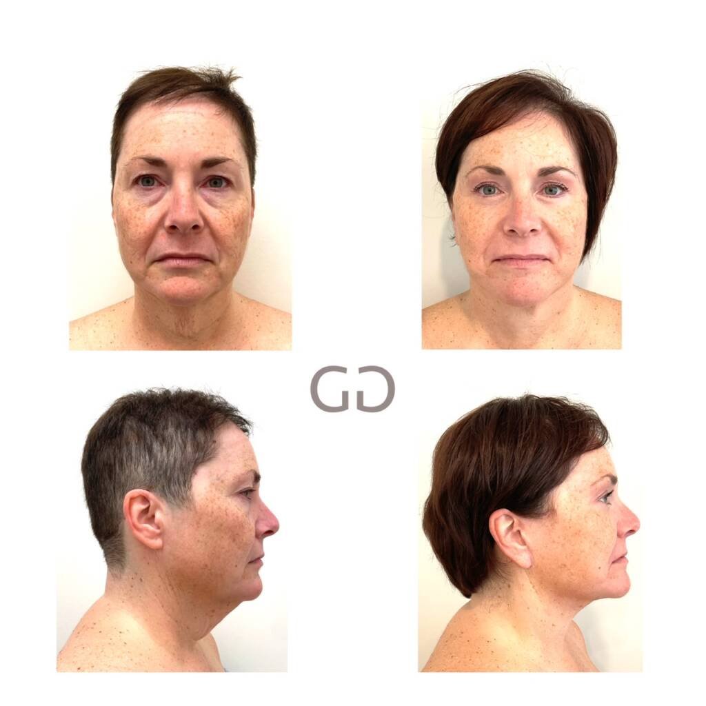 Facelift & Necklift, Montreal