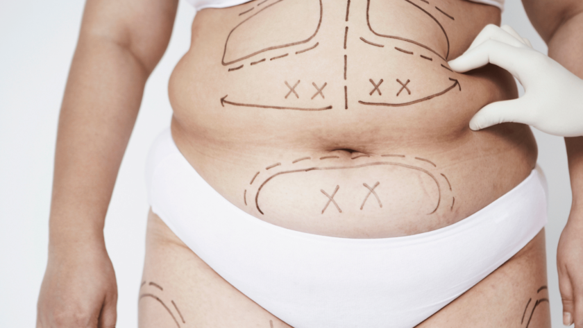 cost of a liposuction