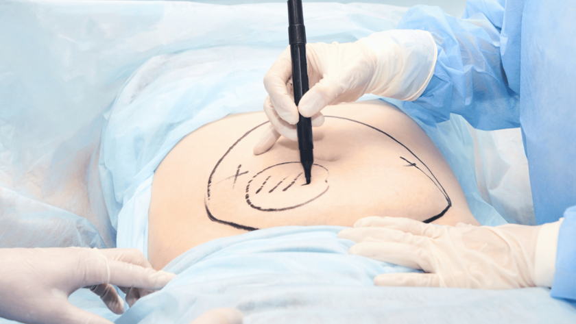 what is liposuction