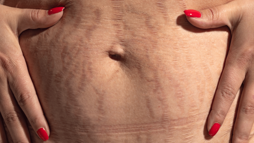 liposuction calgary