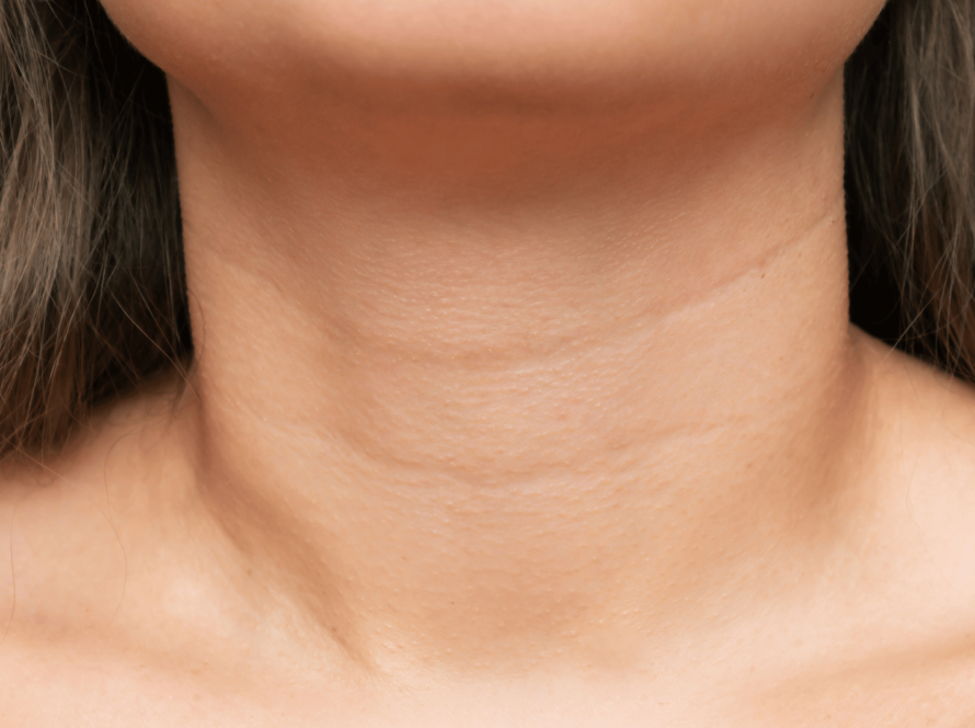 neck liposuction