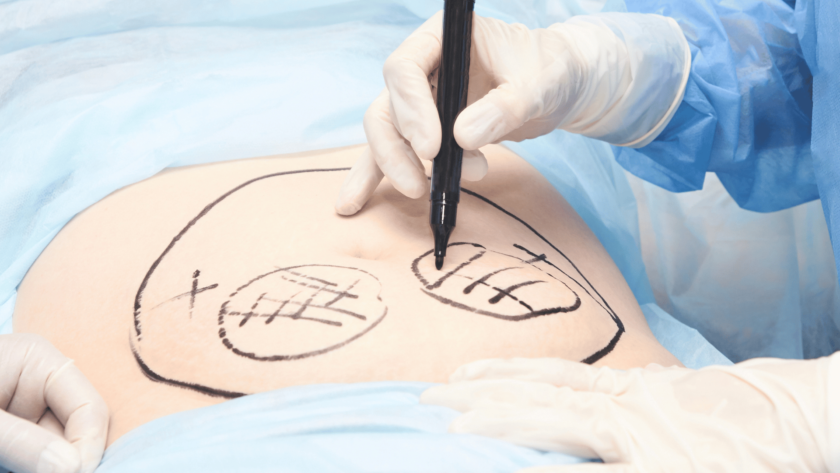 liposuction and liposculpture