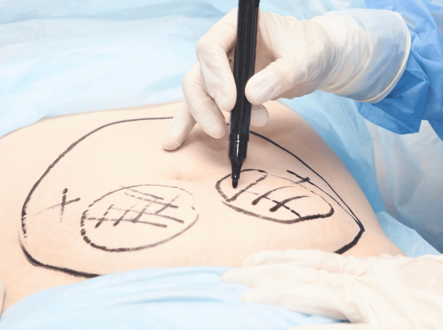 liposuction and liposculpture