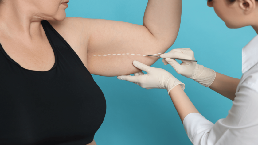 Arm Liposuction