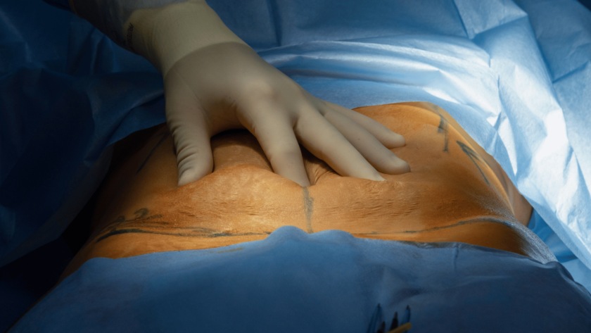 male abdominoplasty